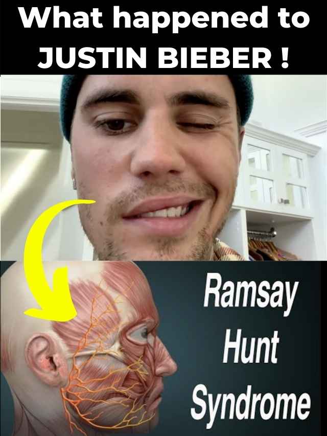 Justin Bieber Ramsay Hunt Syndrome Details